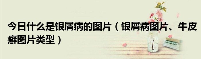 今日什么是银屑病的图片(银屑病图片、牛皮癣图片类型)